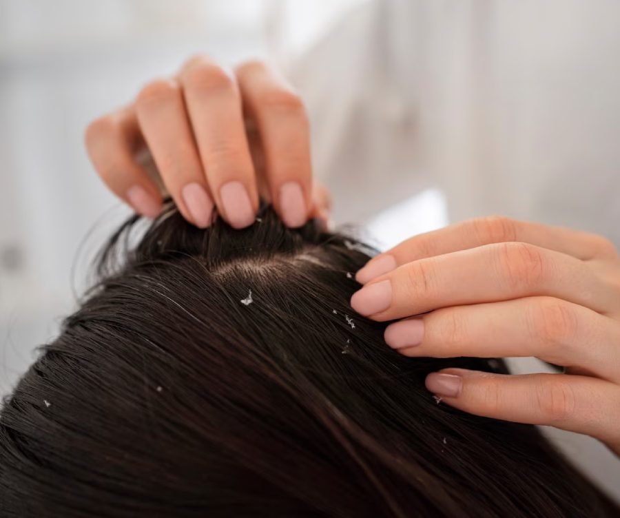 11 Easy Home Remedies for Dandruff That Actually Work 